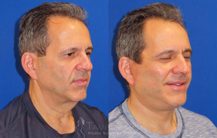 Before & After Facelift Case 24 Oblique #2 View in Doylestown, PA
