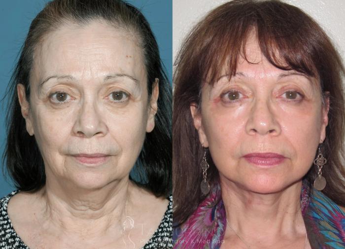 Before & After Neck Lift Case 25 Frontal View in Doylestown, PA