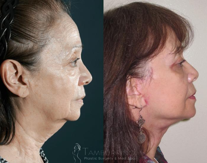Before & After Facelift Case 25 Side #1 View in Doylestown, PA