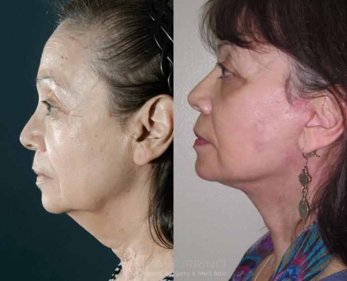 Before & After Facelift Case 25 Side #2 View in Doylestown, PA