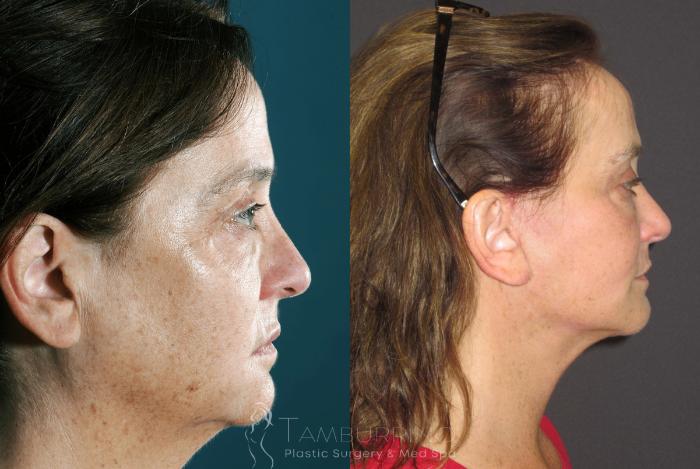 Before & After Facelift Case 26 Side #1 View in Doylestown, PA