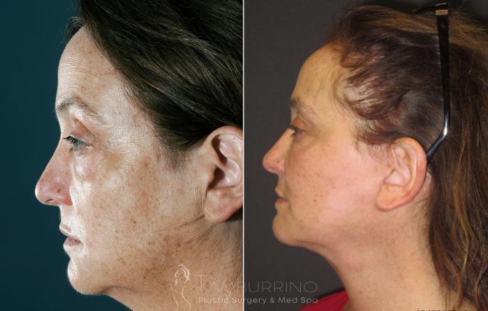 Before & After Facelift Case 26 Side #2 View in Doylestown, PA