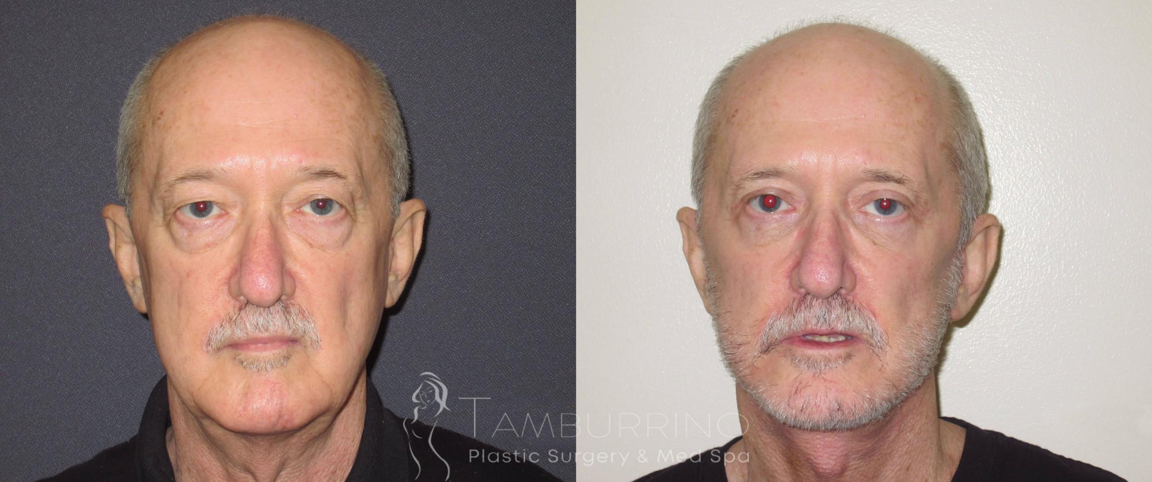Before & After Neck Lift Case 53 Frontal View in Doylestown, PA