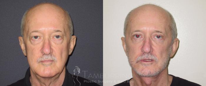Before & After Neck Lift Case 53 Frontal View in Doylestown, PA