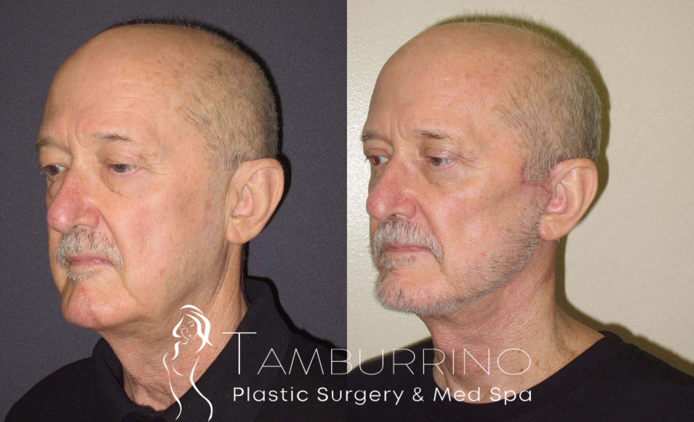 Before & After Neck Lift Case 53 Left Oblique View in Doylestown, PA