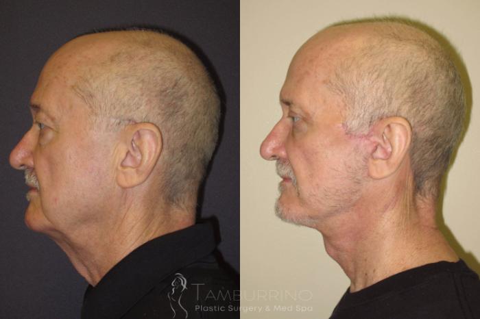 Before & After Neck Lift Case 53 Left Side View in Doylestown, PA