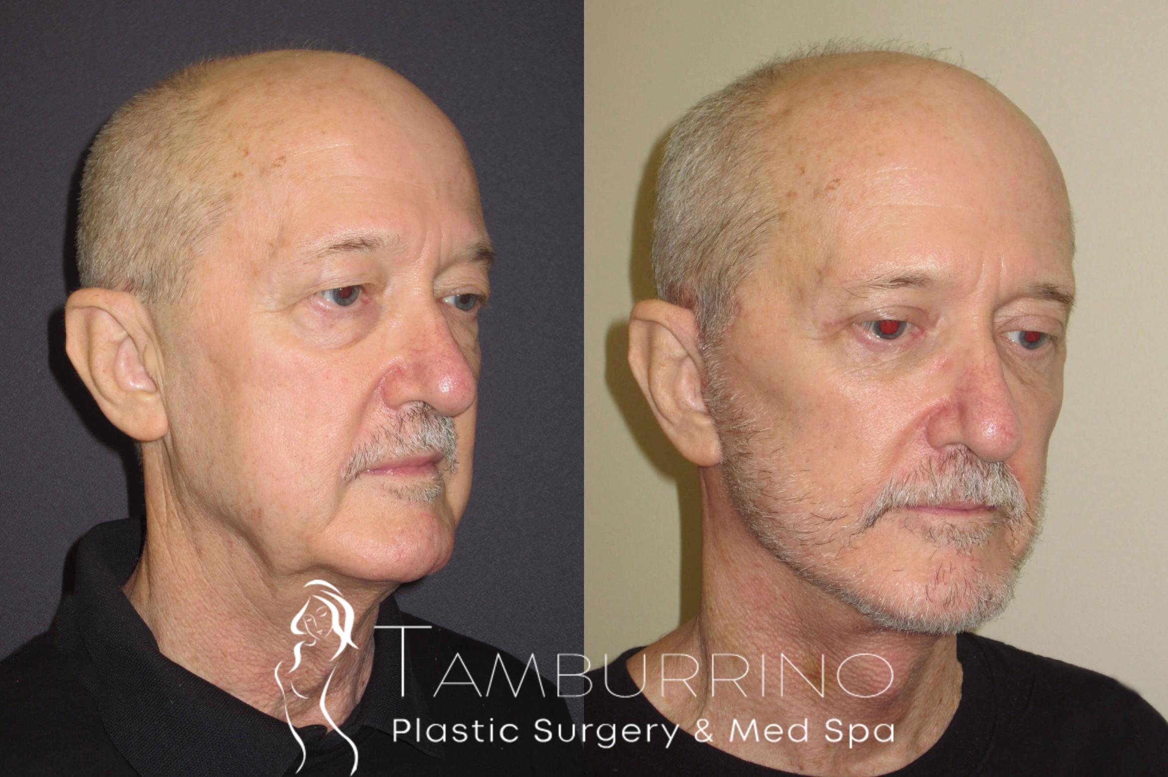Before & After Neck Lift Case 53 Right Oblique View in Doylestown, PA