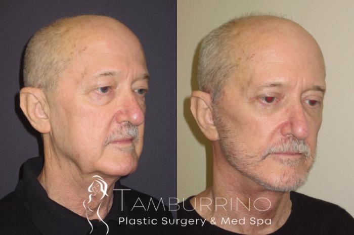 Before & After Neck Lift Case 53 Right Oblique View in Doylestown, PA