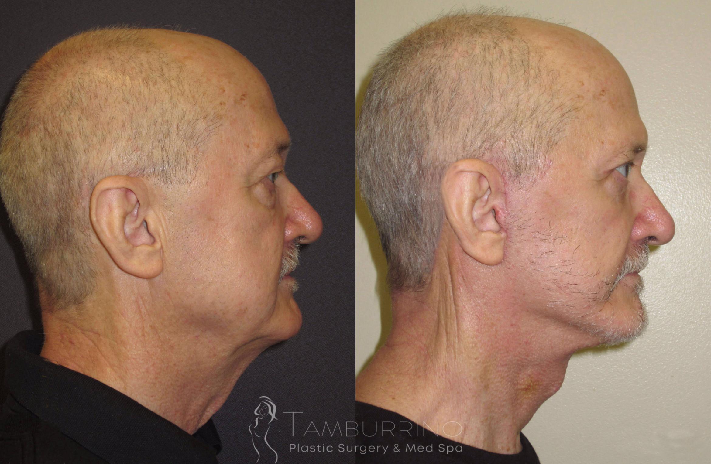 Before & After Neck Lift Case 53 Right Side View in Doylestown, PA