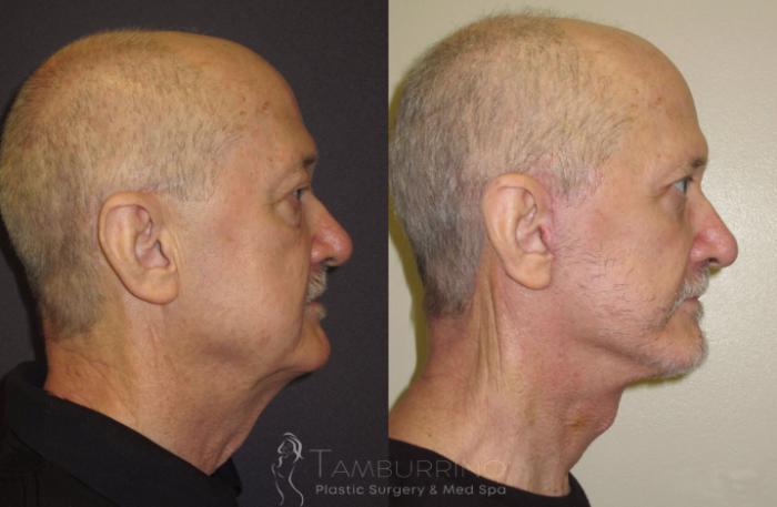 Before & After Neck Lift Case 53 Right Side View in Doylestown, PA