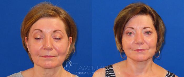 Before & After Neck Lift Case 57 Frontal View in Doylestown, PA