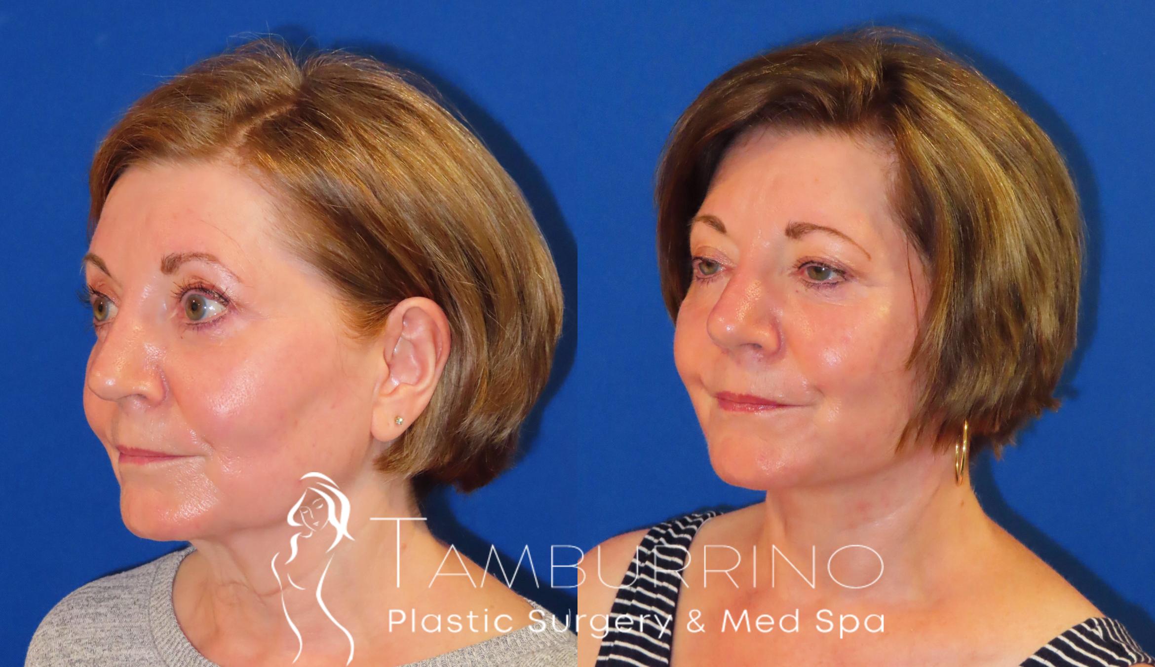 Before & After Facelift Case 57 Left Oblique View in Doylestown, PA