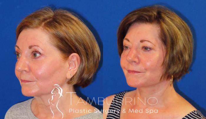 Before & After Facelift Case 57 Left Oblique View in Doylestown, PA