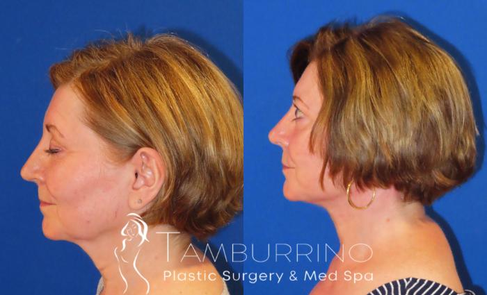 Before & After Facelift Case 57 Left Side View in Doylestown, PA