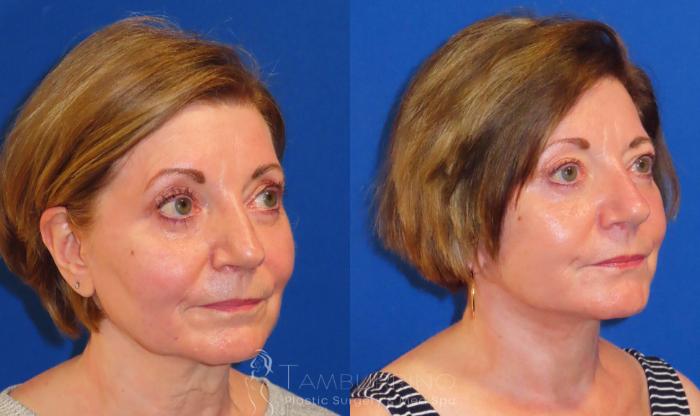 Before & After Facelift Case 57 Right Oblique View in Doylestown, PA