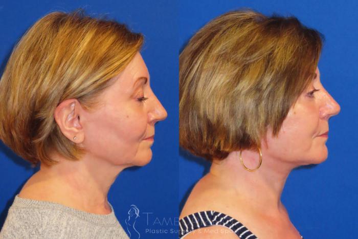 Before & After Facelift Case 57 Right Side View in Doylestown, PA