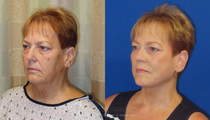 Before & After Facelift Case 65 Left Oblique View in Doylestown, PA
