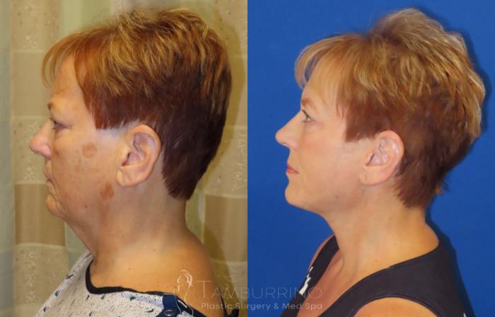 Before & After Facelift Case 65 Left Side View in Doylestown, PA