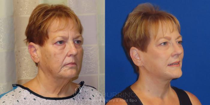Before & After Facelift Case 65 Right Oblique View in Doylestown, PA