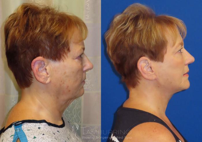 Before & After Facelift Case 65 Right Side View in Doylestown, PA