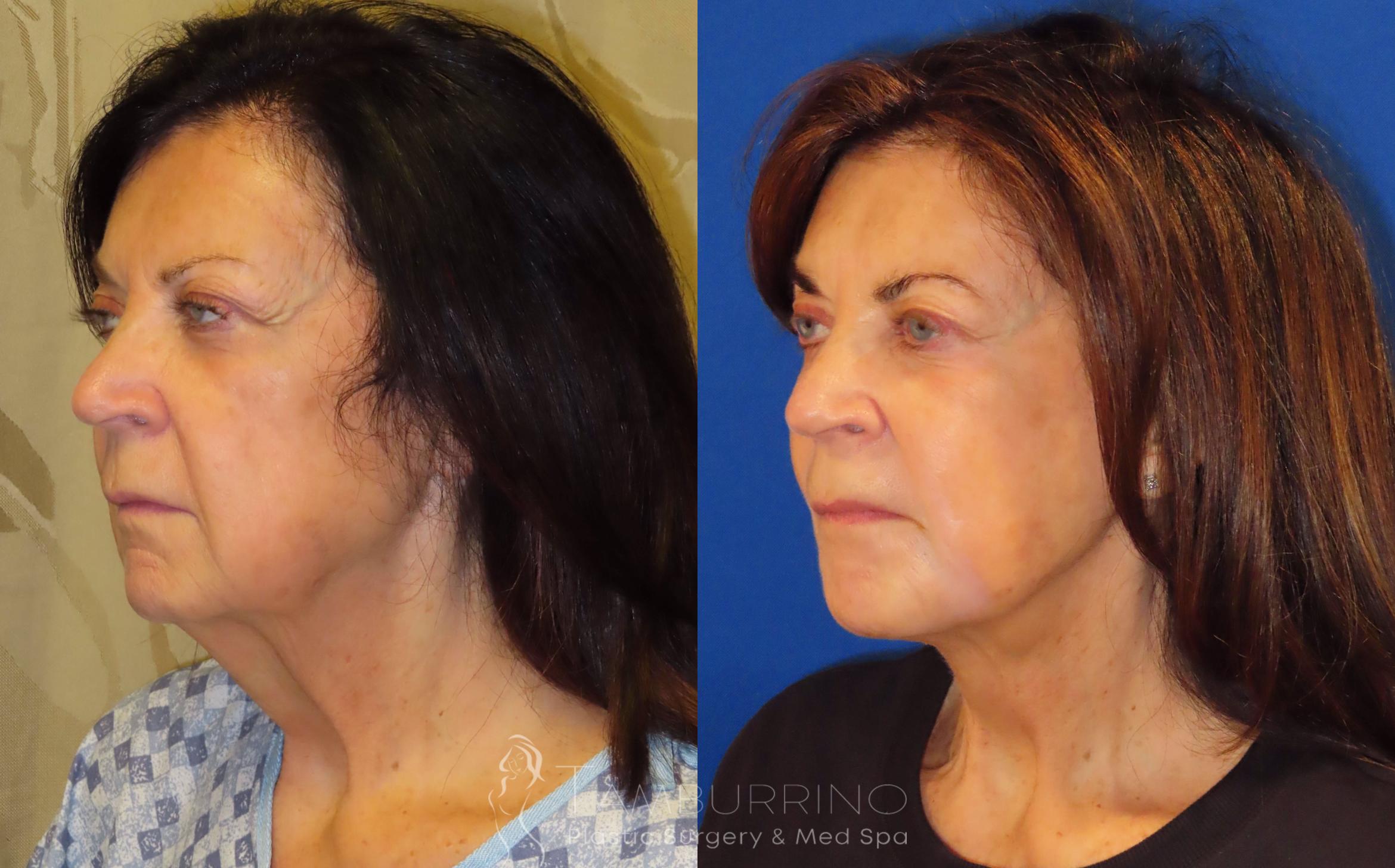 Before & After Facelift Case 66 Left Oblique View in Doylestown, PA