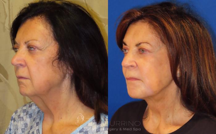 Before & After Facelift Case 66 Left Oblique View in Doylestown, PA