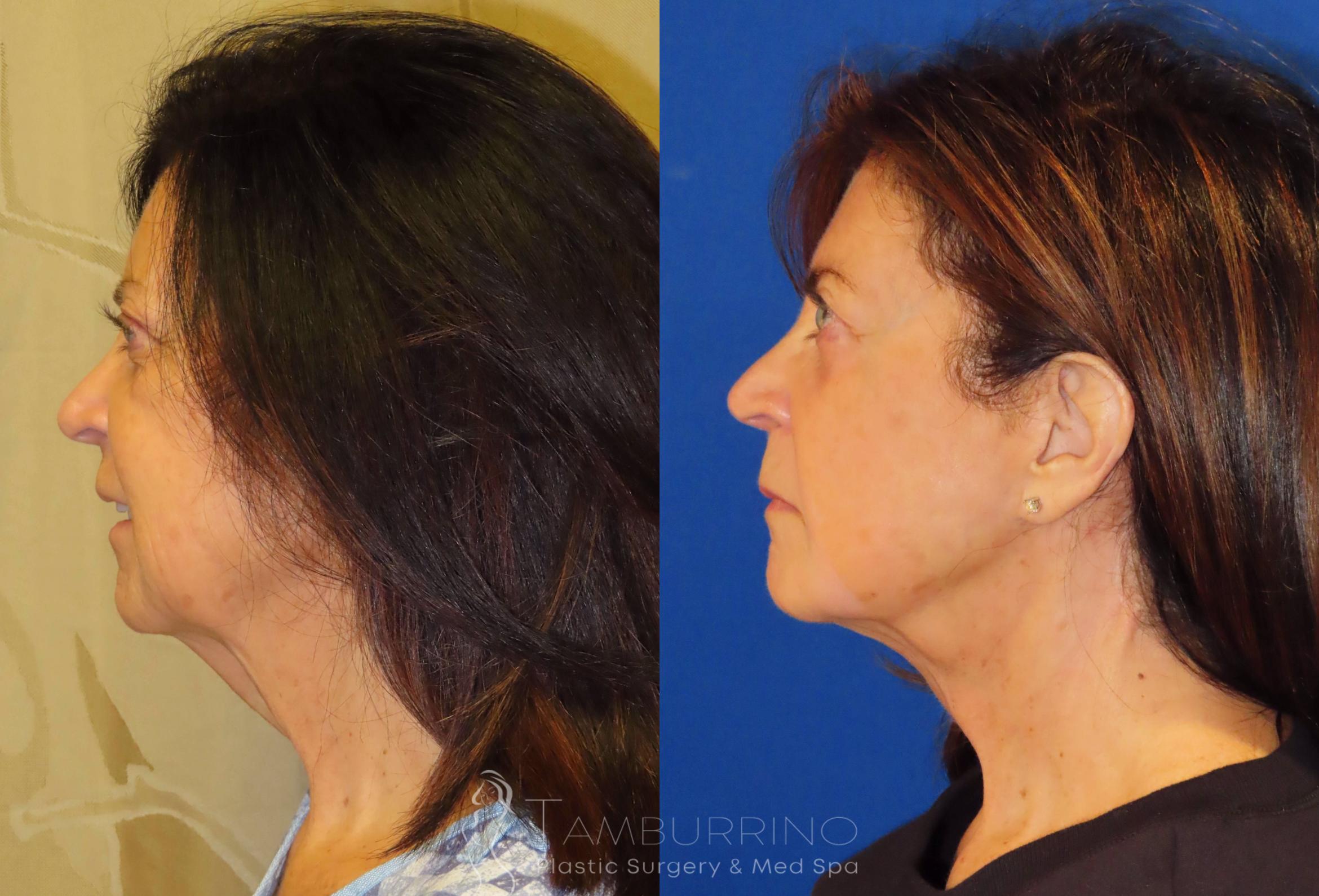 Before & After Facelift Case 66 Left Side View in Doylestown, PA