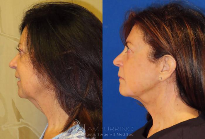 Before & After Facelift Case 66 Left Side View in Doylestown, PA