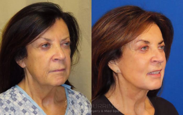 Before & After Facelift Case 66 Right Oblique View in Doylestown, PA