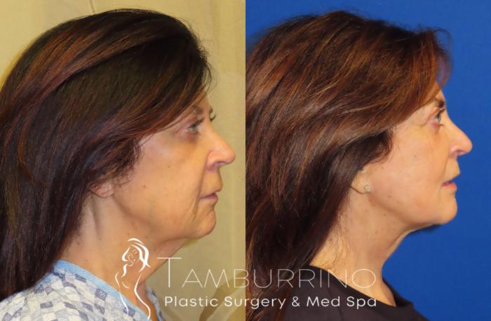 Before & After Facelift Case 66 Right Side View in Doylestown, PA