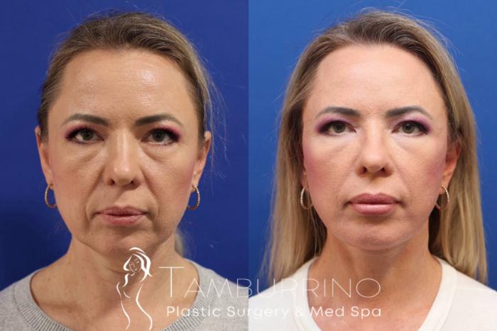 Before & After Facelift Case 75 Frontal View in Doylestown, PA