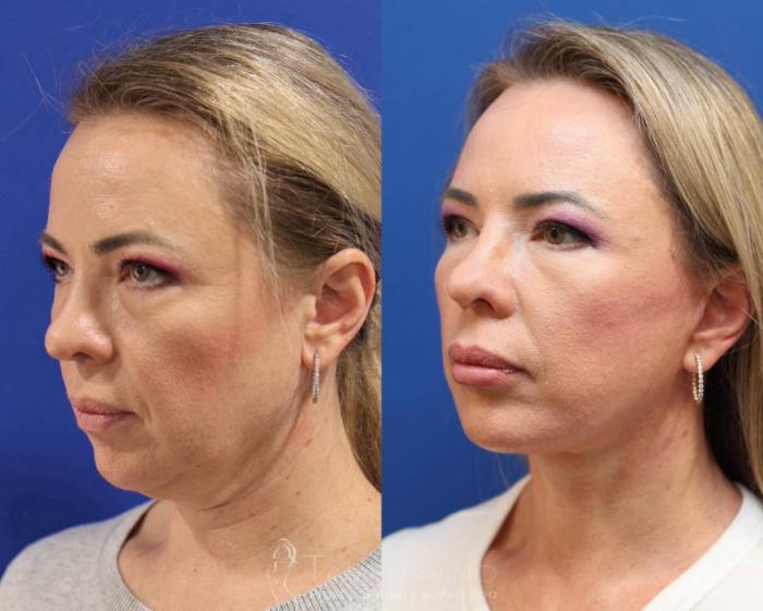 Before & After Facelift Case 75 Left Oblique View in Doylestown, PA