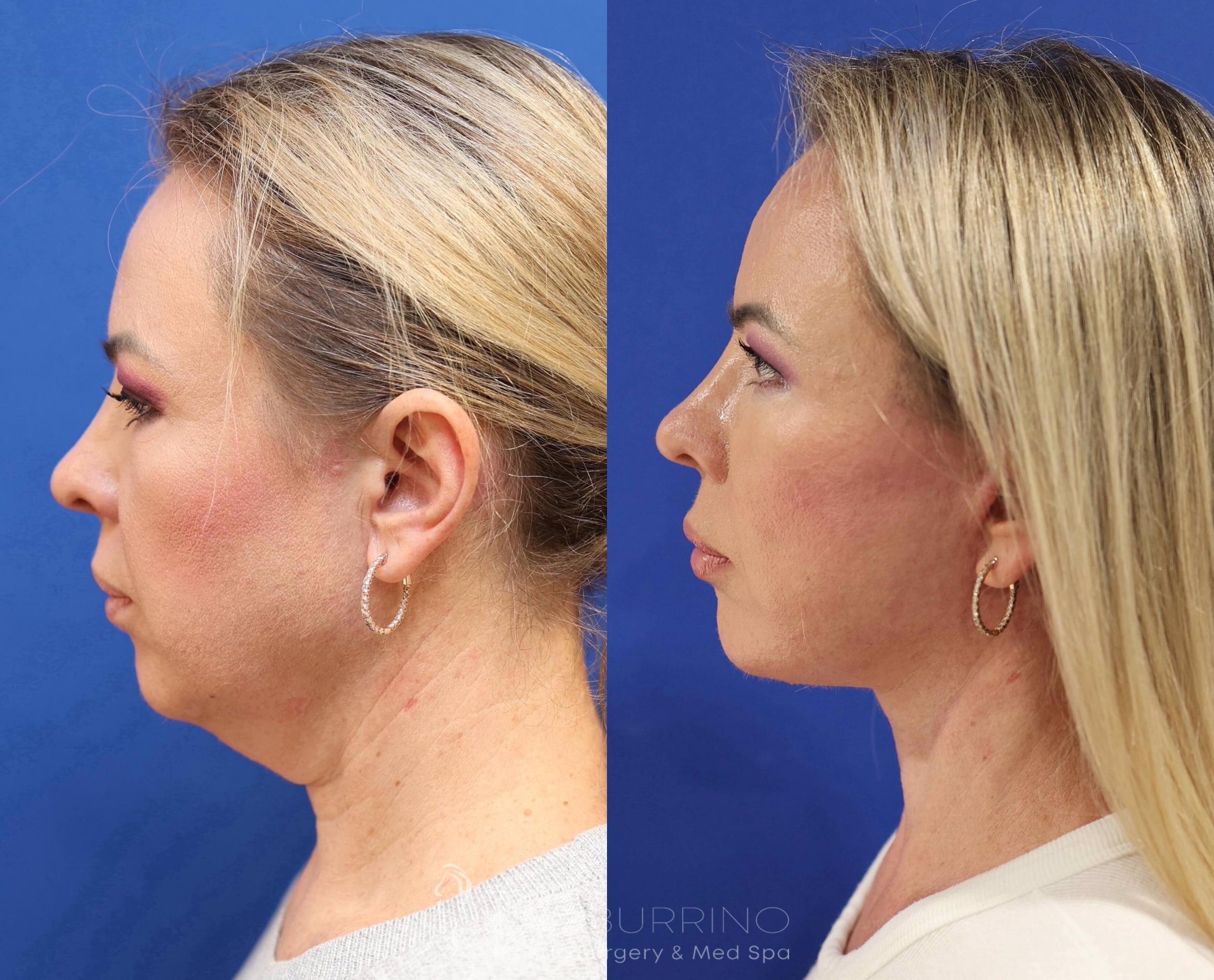 Before & After Facelift Case 75 Left Side View in Doylestown, PA