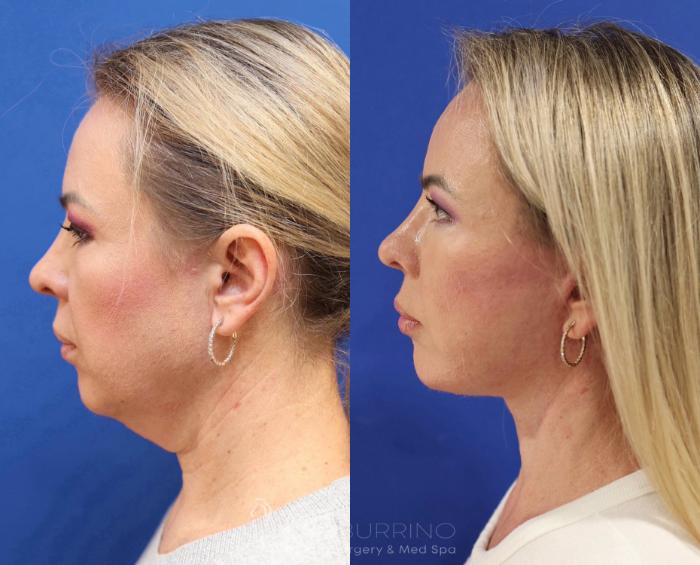 Before & After Facelift Case 75 Left Side View in Doylestown, PA