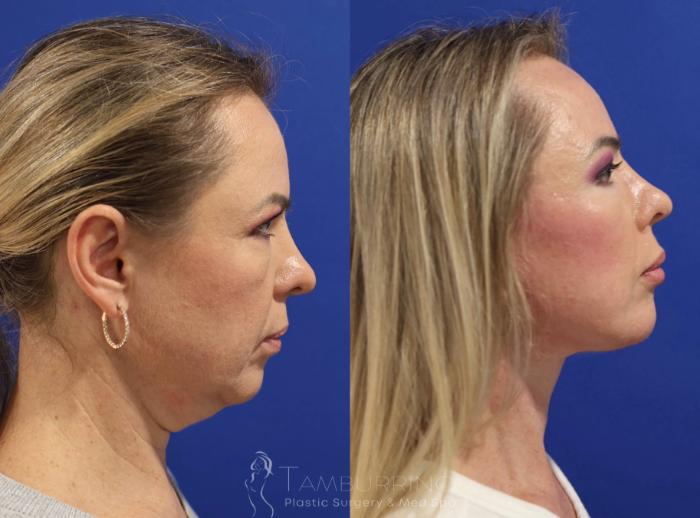 Before & After Facelift Case 75 Right Side View in Doylestown, PA