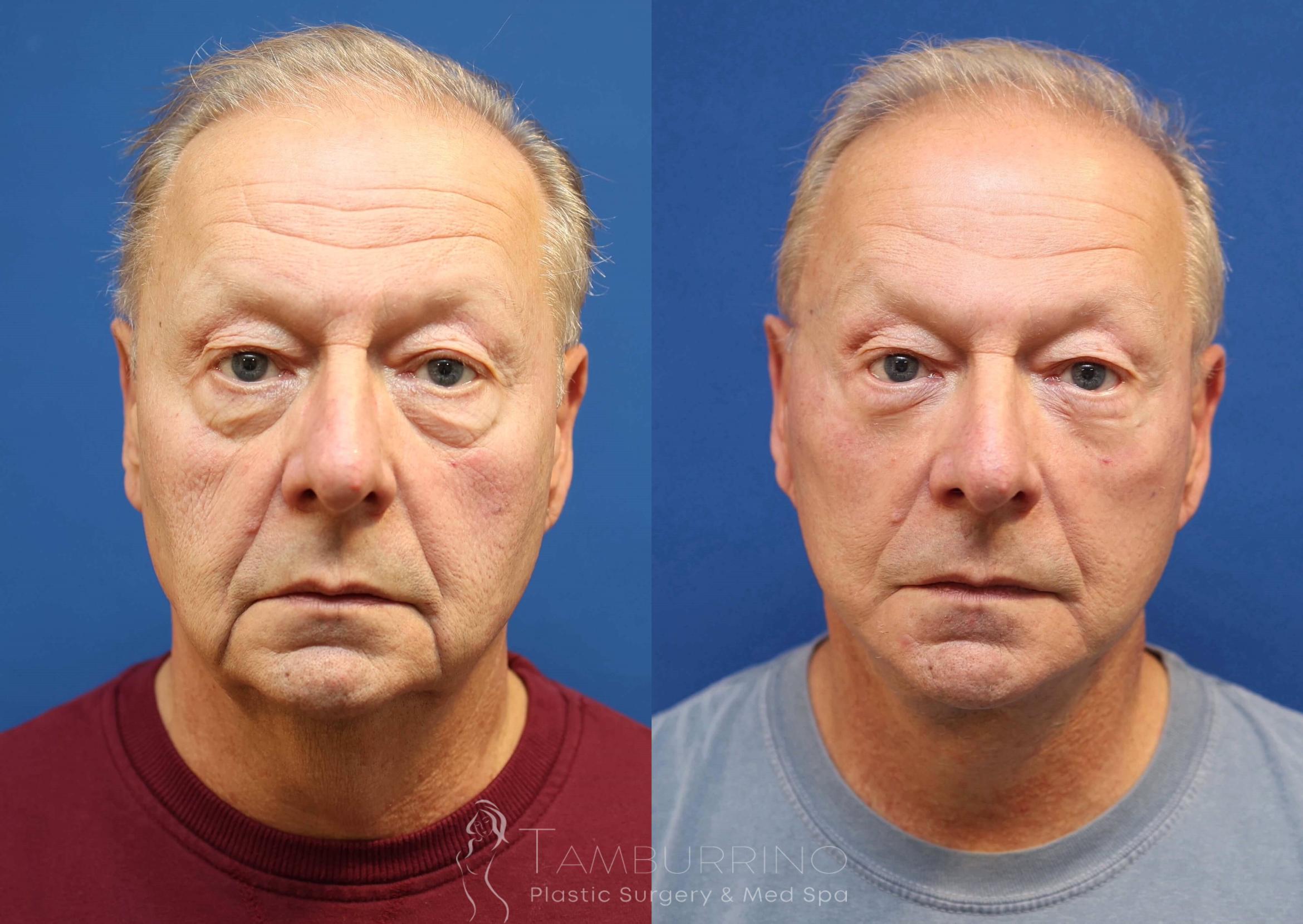 Before & After Neck Lift Case 76 Frontal View in Doylestown, PA