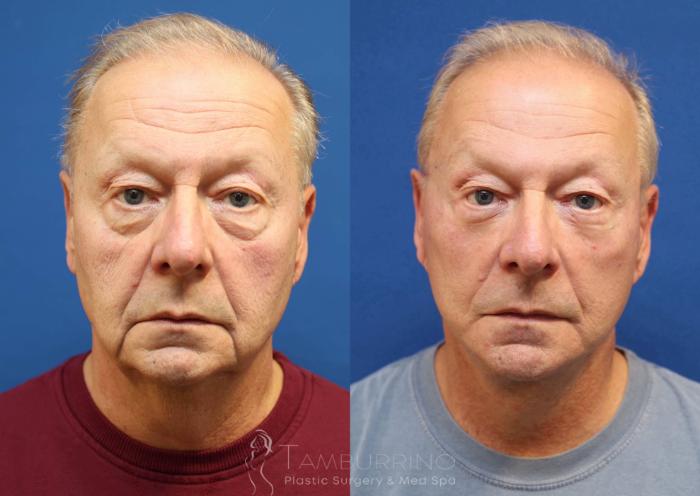 Before & After Neck Lift Case 76 Frontal View in Doylestown, PA