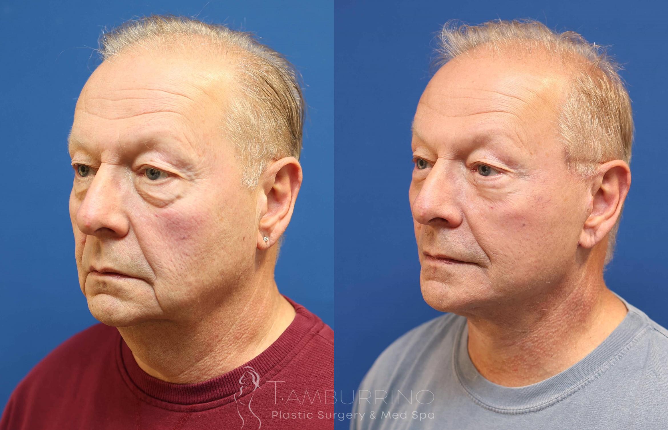 Before & After Neck Lift Case 76 Left Oblique View in Doylestown, PA