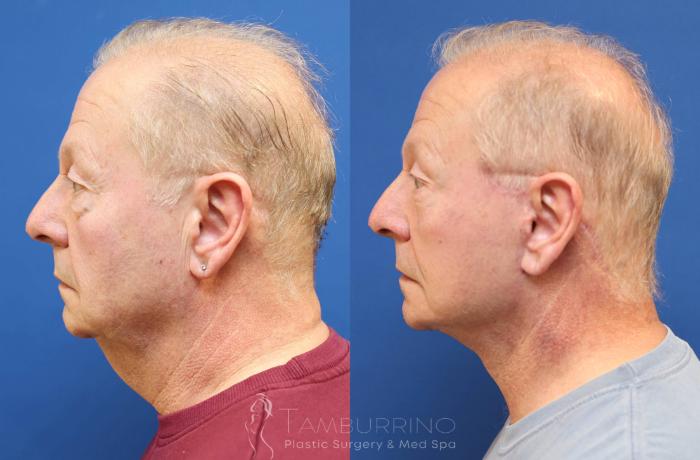 Before & After Neck Lift Case 76 Left Side View in Doylestown, PA