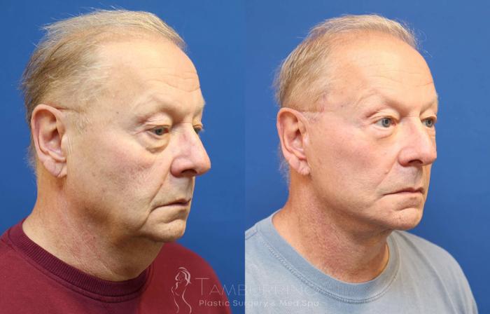 Before & After Neck Lift Case 76 Right Oblique View in Doylestown, PA