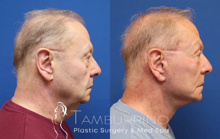Before & After Neck Lift Case 76 Right Side View in Doylestown, PA