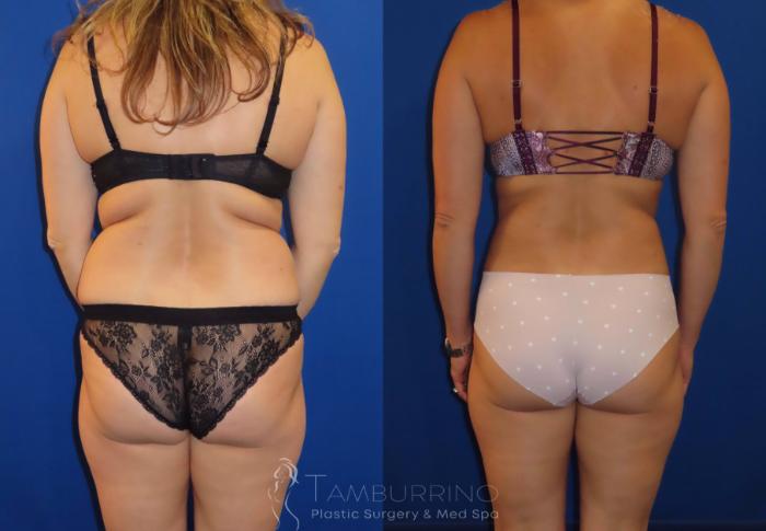 Before & After Liposuction Case 21 Back View in Doylestown, PA