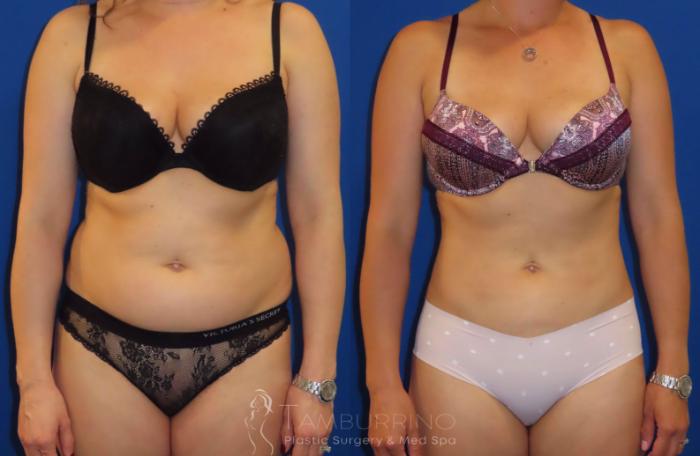 Before & After Smartlipo® Case 21 Frontal View in Doylestown, PA