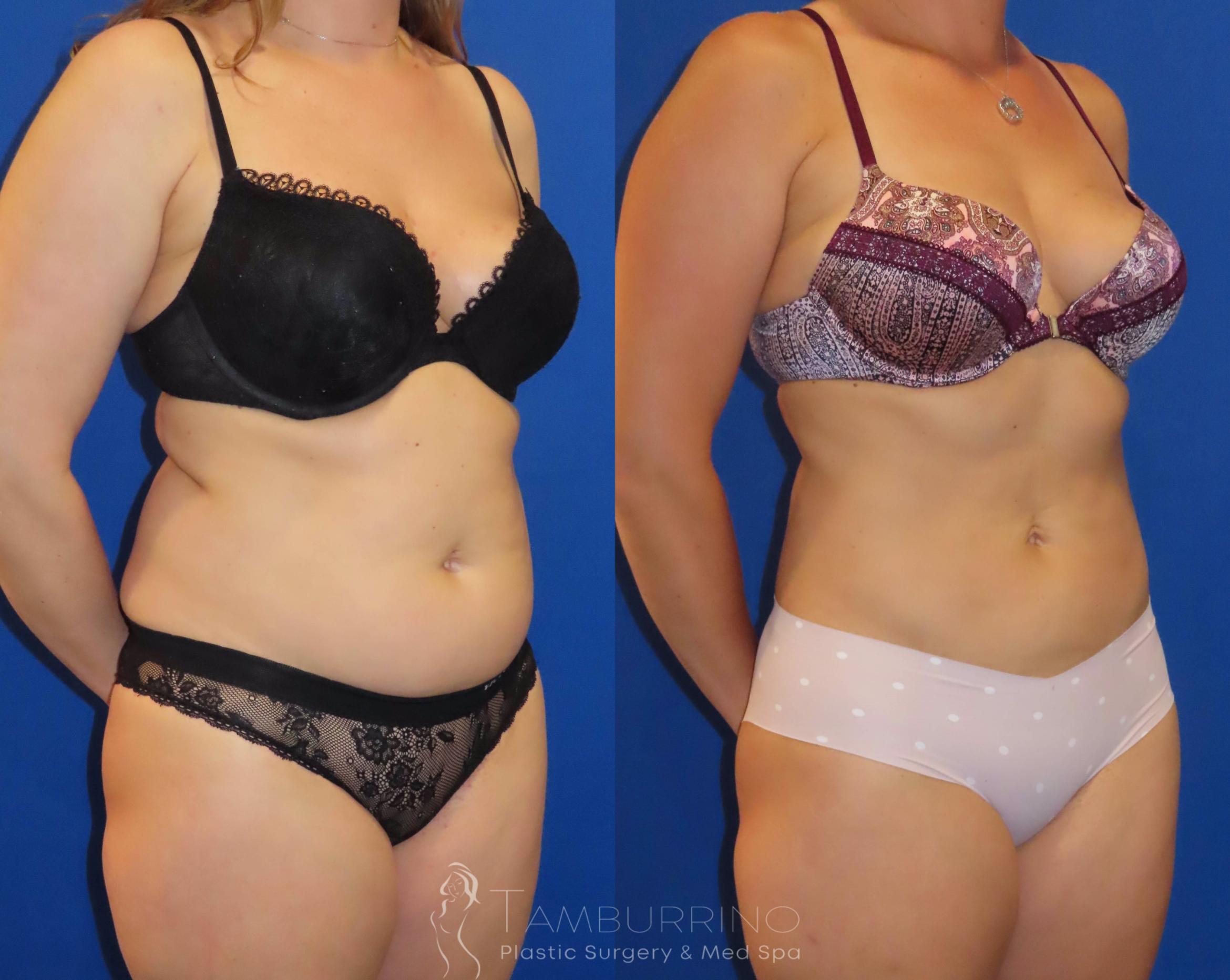 Before & After Liposuction Case 21 Oblique View in Doylestown, PA
