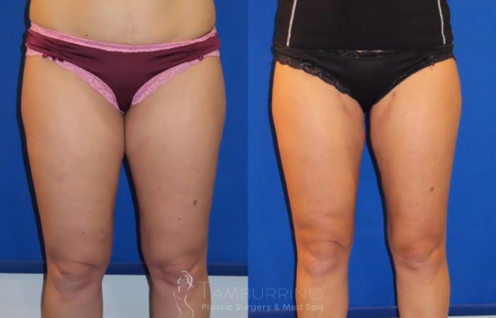 Before & After Smartlipo® Case 22 Frontal View in Doylestown, PA