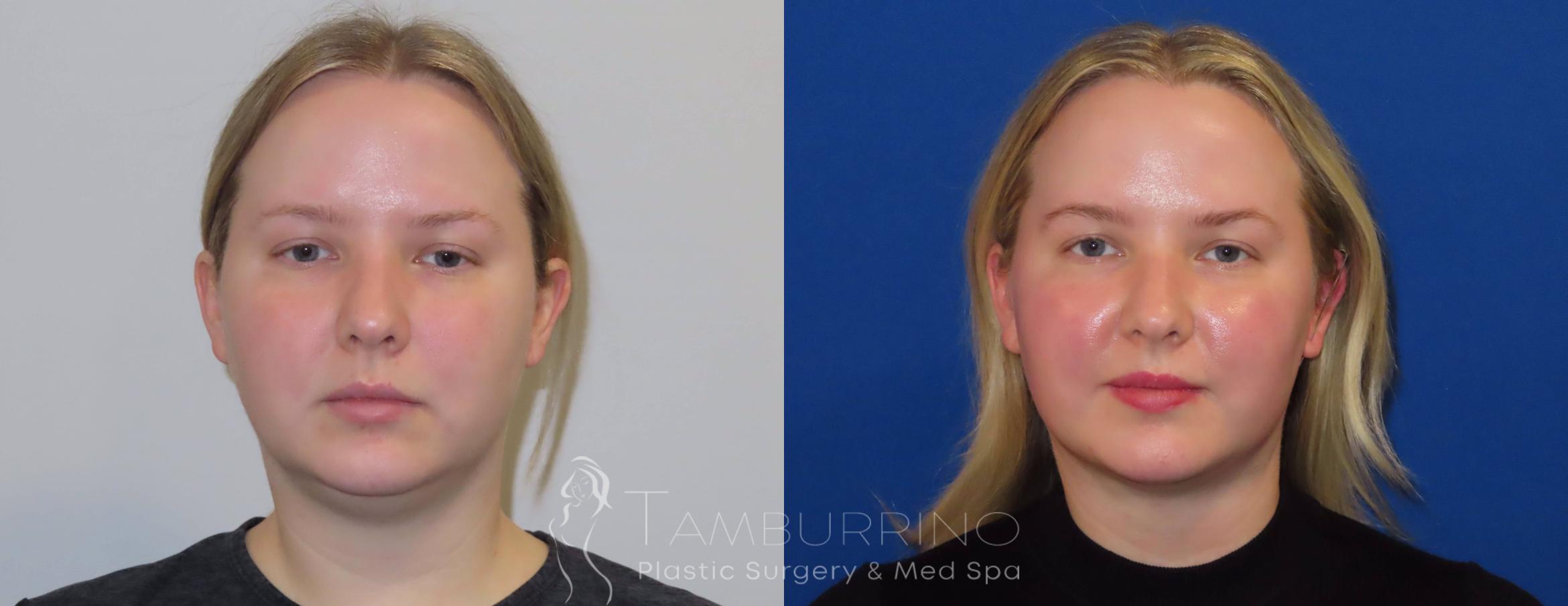 Before & After Liposuction Case 23 Frontal View in Doylestown, PA