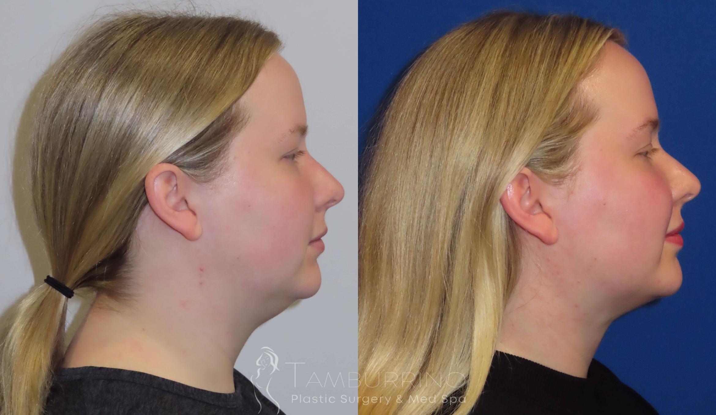 Before & After Liposuction Case 23 Lateral #1 View in Doylestown, PA