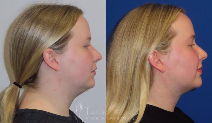 Before & After Liposuction Case 23 Lateral #1 View in Doylestown, PA
