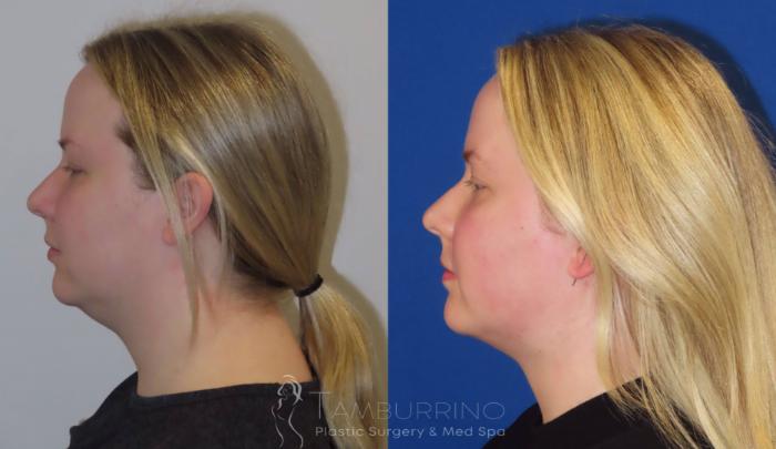 Before & After Liposuction Case 23 Lateral #2 View in Doylestown, PA