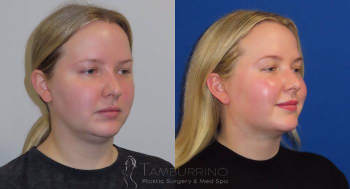 Before & After Liposuction Case 23 Oblique #1 View in Doylestown, PA